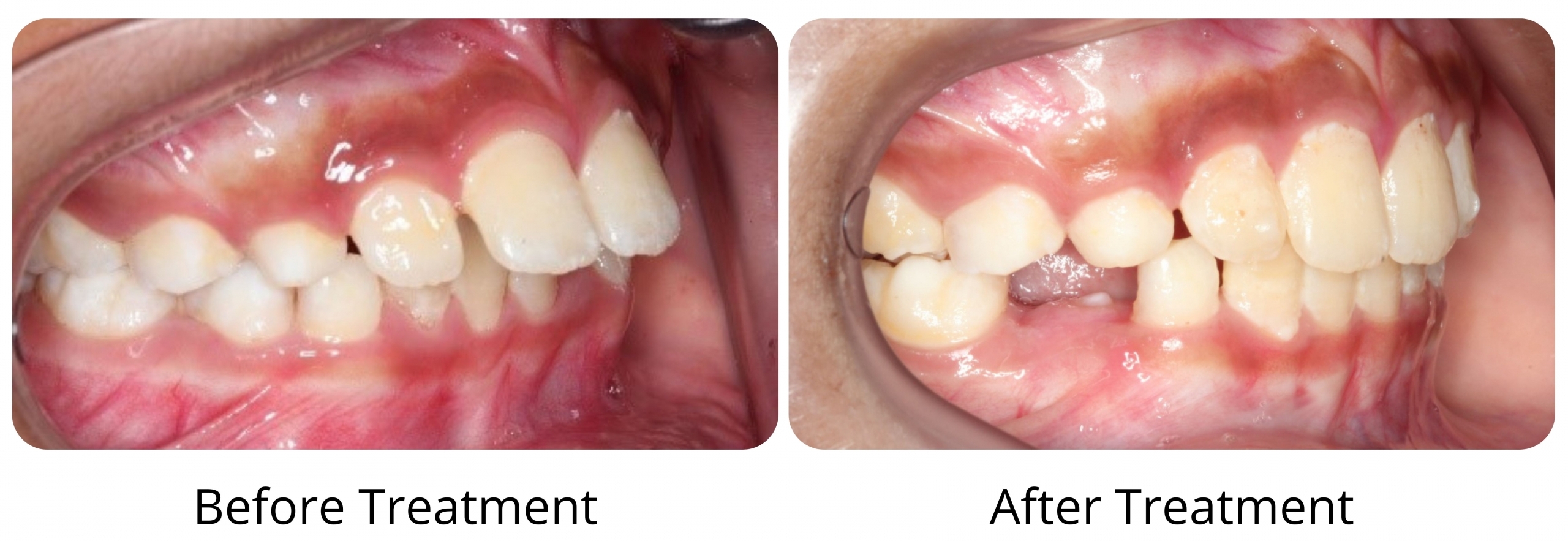 The foundation behind successful tooth movement : TRISTAR-Aligner Material