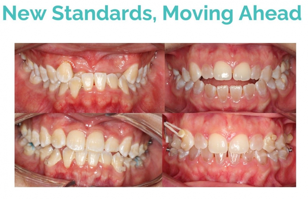 New standards, Moving ahead with Tristar! : TRISTAR-Aligner Material