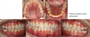Composite clear aligner treatment in a pseudo class III malocclusion case complicated with increased curve of Spee : TRISTAR-Aligner Material